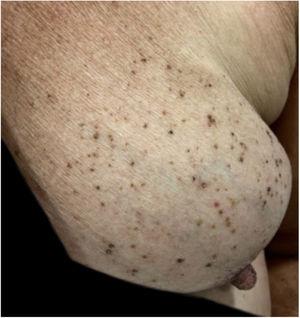 Detail of multiple brownish, rounded, well-defined papules with a greasy surface, restricted to the left breast.