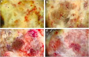 (A) Dermoscopy shows a multicolored pattern, with a diffuse yellow background (*) and some irregularly distributed red, brown, and gray areas (**). “Fiber sign”: observation of the atypical polymorphic vascular component is hindered by gauze filaments trapped into the irregular surface of the tumor. (B) Vessels appear atypical, polymorphic, and mainly dilated (arrows). (C) Dermoscopy reveals a multicolored pattern, with a diffuse red and white background and some yellow, brown, and gray areas irregularly spread on it (triangle). (D) Atypical vessels over a red and white background are clearly visible.