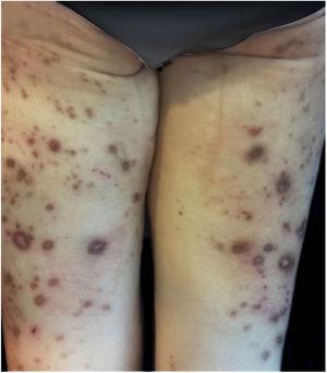 Clinical presentation of a 65-year-old female with generalized umbilicated, hyperpigmented, and excoriated papules and nodules.