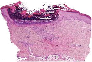 Photomicrograph showing a cup-shaped depression of the epidermis, with an overlying keratin plug containing collagen fibers, keratinous debris, and inflammatory cells (Hematoxylin & eosin, ×100).
