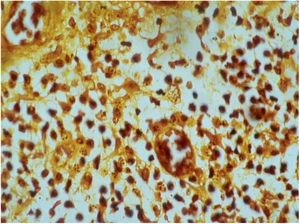Histopathology showing the presence of Donovan bodies. Warthin-Starry staining (Image credits: Professor Luis Carlos de Lima Ferreira).