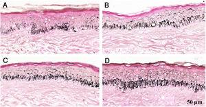 Histological sections of skin with melasma and normal adjacent skin samples stained with Fontana-Masson before and after irradiation with 1.524 mJ/cm2 UVB, revealing an increase in the basal melanin density in the different samples. (A), normal adjacent skin before UVB irradiation; (B), normal adjacent skin after UVB irradiation; (C), skin with melasma before UVB irradiation; (D), skin with melasma after UVB irradiation.