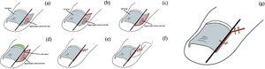 Standardized six steps for ingrown toenail.