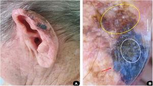 (A), Pigmented, multicolored, asymmetric lesion, with slightly elevated areas on the helix of the left ear. (B), Dermoscopy suggestive of superficial spreading melanoma: blue-white veil (red arrow); irregular dots and globules (white circle); area with rhomboidal structures and asymmetric pigmentation of follicular ostia (yellow circle); white depigmentation area (white arrow).