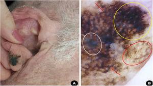 (A), Asymmetric, blackened macula on the right ear lobe. (B), Dermoscopy suggestive of superficial spreading melanoma: bluish-white veil (white circle), homogeneous area with obliterated hair follicles and irregular streaks (yellow circle); rhomboidal structures (red arrow); circle within circle (red circle).
