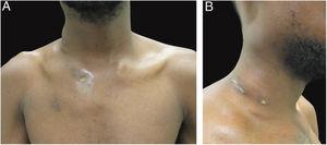 Clinical aspect of the patient. (A − B) dermatosis located on the right side of the cervical and upper thoracic regions characterized by cold and painless abscesses up to 5 cm in diameter, some with fistulization and ulcers.