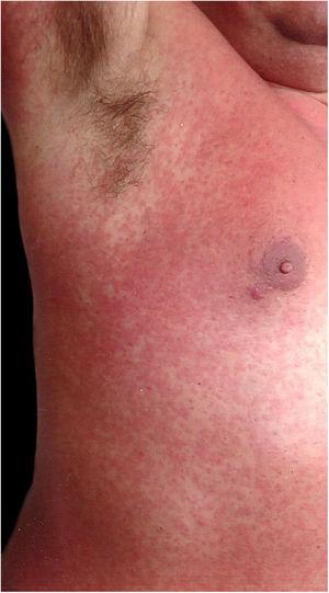 Overview of the rash. Rubelliform rash, on the third day of clinical evolution. The right axillary region was spared.