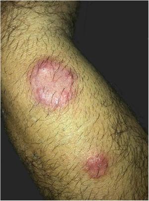 Clinical aspect of the lesions: nummular erythematous plaque, with peripheral pustules and tonsured hair, located on the right forearm, associated with a satellite lesion with the same characteristics.