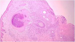 Histological section shows an enlarged hair follicle and inflammatory reaction in the superficial dermis, with a predominance of mononuclear cells (Hematoxylin & eosin, ×100).