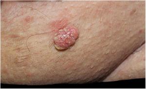Erythematous verrucous plaque with yellowish structures in the pubic region.