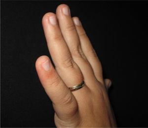 Erythematous macula on the dorsal surface of the fifth finger of the left hand.