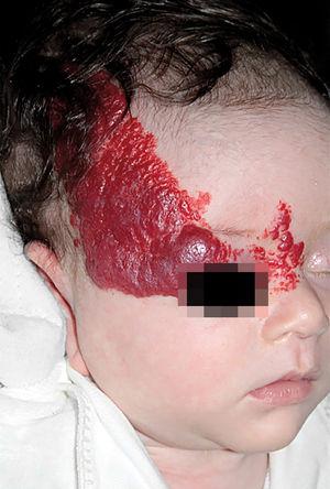 Infantile hemangioma on the frontotemporal segment