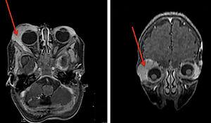 Brain MRI with a hemangioma on the right periorbital region