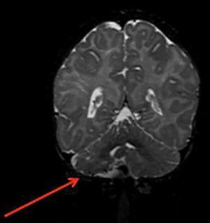Brain MRI showing hypoplasia of the right cerebellum