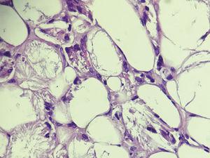 Intracytoplasmic needle-shaped deposits in the adipocytes (Hematoxylin & eosin, X400)