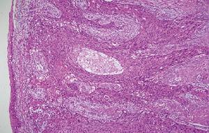 Squamous cell carcinoma arising in a sacrococcygeal tailgut cyst ...