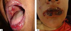A. Vesicles, blisters, and exulcerations on the lips. Exulcerations in the buccal and palate mucosa; B. Serohematic exulcerations and crusts on the lips