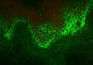 Direct immunofluorescence examination showing moderate intensity for the IgG and C3 markers, with intercellular fluorescence distribution, often with predominant location in the lower layers of the epithelium