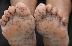 Multiple, bilateral palpable petechiae and purpura on the soles.