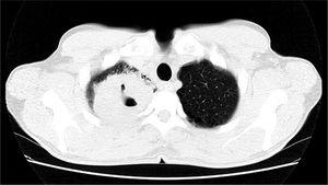 Computed tomography scan of the chest showing cavitation with a thick wall in the right upper lobe amid consolidations in other pulmonary areas.