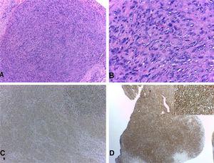 Epidural lesion. (A and B), confused lesion by spindle cell bundles with low atypia (Hematoxylin & eosin ×100 and ×400, respectively). (C and D), SMA and H-caldesmon positive immunohistochemistry, respectively.