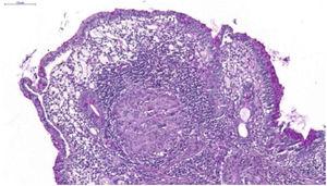 Non-caseating granulomas in the ileal mucosa (Hematoxylin & eosin, ×10).