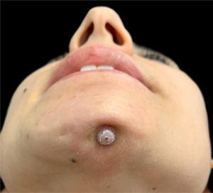Erythematous nodule with surrounding retraction on the chin.