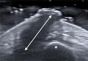 Ultrasonography examination reveals a wide hypoechoic band (arrow) extending through the subcutaneous tissue to the mandibular bone (asterisk).