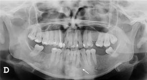 Panoramic radiograph showing radiolucency around the root of the mandibular left lateral incisor (arrow).