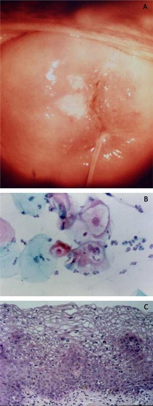 (A) Colposcopy; (B) oncotic cytopathology; (C) histopathological of the epithelium showing loss of stratification and nuclear polymorphism (Hematoxylin & eosin, 300×).