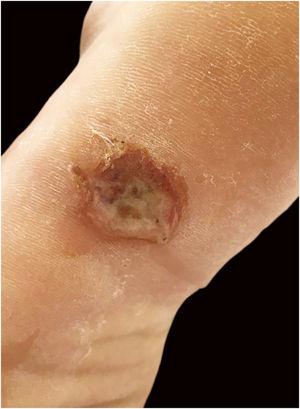 Ulcer with raised edges on the left plantar region.