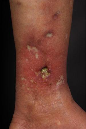 Achromic maculae with well-defined edges, Milian’s white atrophy, erythematous maculae, and an ulcer measuring 1.5 cm in diameter, on the medial aspect of the left lower limb.