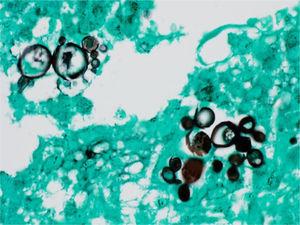 Paracoccidioidomycosis and liver transplantation: multi-budding fungal cells, characteristic of the Paracoccidioides genus (Grocott-Gomori. Immersion).