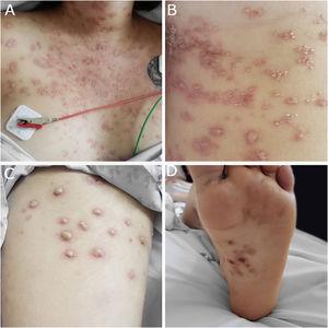(A) Papules and plaques on chest with peeling and pustules. (B) Pustules on abdomen associated with erythema. (C) Huge pustules on thigh sur erythematous base. (D) Hemorrhagic crusts on the foot sole.