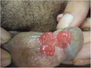 Well defined, erythematous, fleshy, lobulated, sessile growth involving glans, coronal sulcus and shaft of penis.