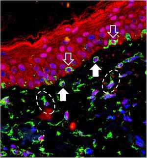 Overlapping image of triple-labeling immunofluorescence on skin with melasma. Labeling in green (vimentin), red (Opsin-3), blue (cell nuclei). White outline arrow: melanocytes in the basal layer. Full white arrow: pendulous melanocytes. Dashed ellipses: upper dermis fibroblasts.