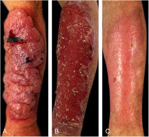 (A) Friable tumor with a mucoid aspect; (B) Post-detachment of the mucoid and necrotic plaque; (C) Healing at 120 days.