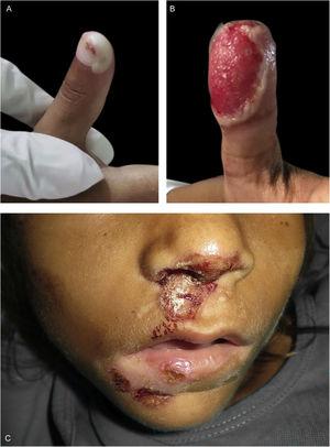 (A) Blister on the distal phalanx of the right thumb. (B) ulceration outlined by an epidermal flap on the distal phalanx of the left thumb. (C) crusted erosions and hypochromic areas on the nose and lips.