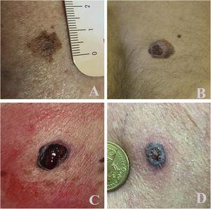 Examples of lesions and image quality acquired with mobile phones and sent to galliera.telederm.it: (A),83-year-old man, back: T1a melanoma; (B), 36-year-old man, back: T2b melanoma; (C), 68-year-old women, left flank: T3b melanoma; (D), 72-year-old man, left arm: pigmented basal cell carcinoma.
