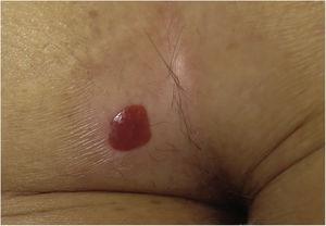 Well delimited erythematous shiny plaque on the left buttock, surrounded by a hypopigmented area.