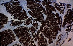 Immunohistochemical study showing strong and diffuse immunoreactivity for synaptophysin.