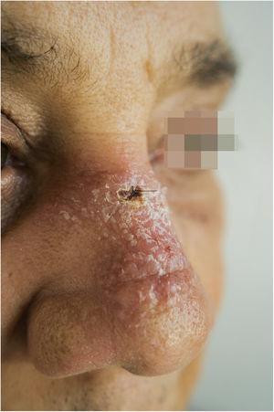Erythematous, scaling plaque on the nose.