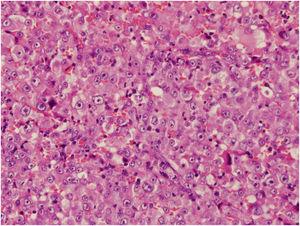 Histological features show neoplastic monomorphous atypical cells, with eosinophilic or vacuolated cytoplasm proliferation in a solid pattern (Hematoxylin & eosin, ×400).