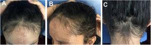 Case 3: (A), Frontal fringe. (B), Hair rarefaction on the temporal region and (C), occipital hair regrowth fringe after effluvium post-weight loss.