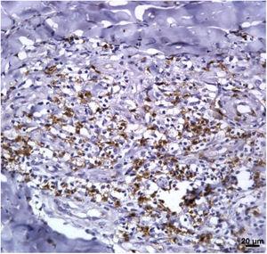 Skin fragment of CL ulcer showing immunohistochemical reaction evidencing CD8+ T-cells (×400).