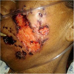 Large, necrotic face ulcers affecting the cheek and the oral mucosa.
