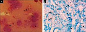 Face ulcer examinations. (A), Budding yeast cells and (B), PAS stained blastoconidia are observed on a Gram smear and on histopathology, respectively.