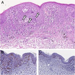 Bowen’s Disease Of The Penile Shaft Presenting As A Pigmented Macule 