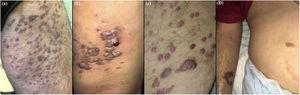 Clinical presentation of Kaposi’s Sarcoma in four patients: (A–C), papulo-nodular, violaceous lesions on the lower extremities (the most common clinical presentation); (D), a small number of violaceous patches in the upper limb and abdomen in an HIV patient.