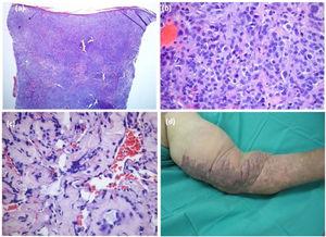 Anaplastic variant of Kaposi’s Sarcoma: histological (A-C), and clinical (D), pictures. Dense tumoral proliferation in the dermis (A, Hematoxylin & eosin ×40), mainly composed of epithelioid cells with pleomorphism and frequent mitoses (B, Hematoxylin & eosin ×400). (C), Dissection of collagen bundles by vascular clefts with atypical endothelial cells (Hematoxylin & eosin ×200). (D) Large and infiltrated violaceous plaque with papillomatous areas in the left upper limb.